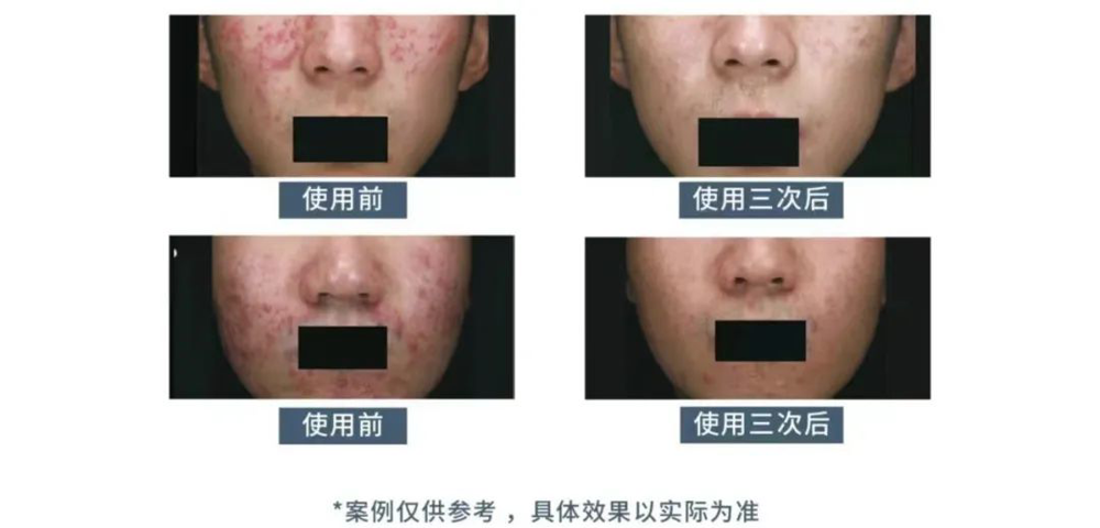 煥膚“肌”密 刷酸之旅|南丹縣中醫醫院皮膚科開展刷酸治療