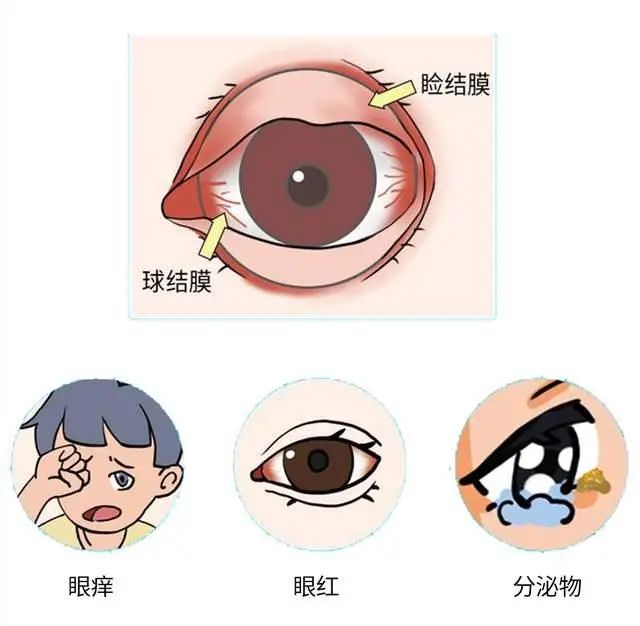 【健康科普】眼部又紅又癢，可能是過敏性結膜炎